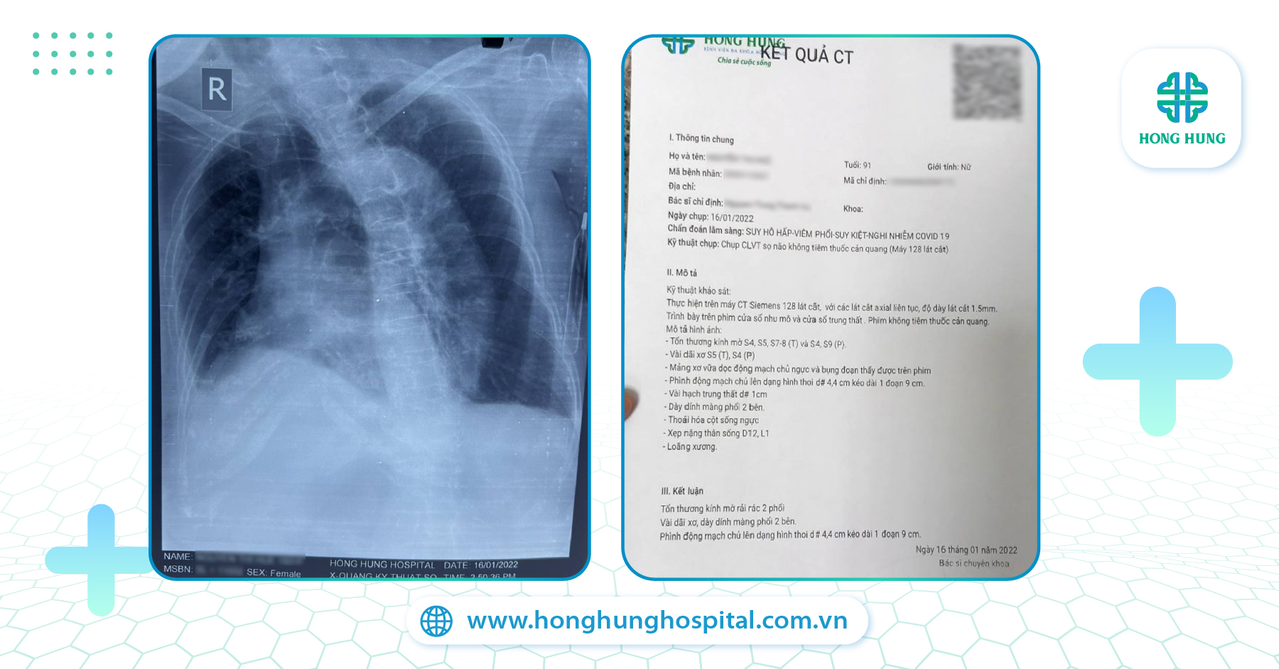 Kết quả CT & chụp X-quang phổi của Bệnh nhân cho thấy có tổn thương kính mờ rải rác ở 2 bên và vài dãi xơ, dày dính màng phổi 2 bên