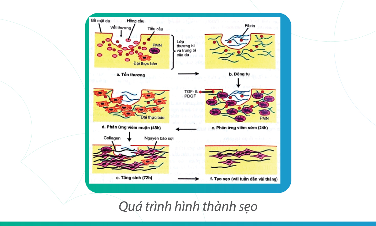 những phương pháp điều trị sẹo phù hợp cho 3 loại sẹo